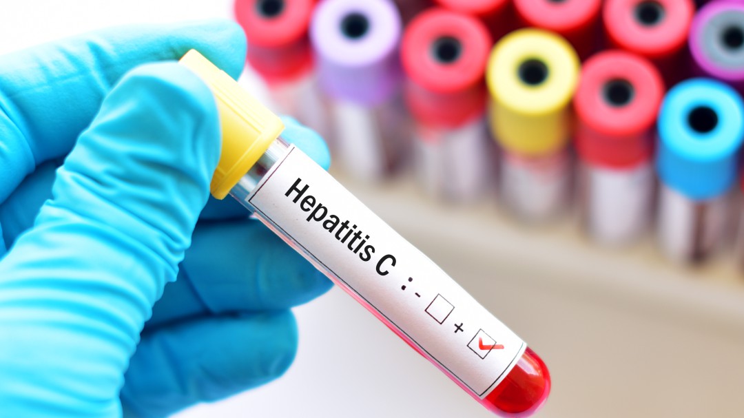 Aragón quiere acabar con la hepatitis C en dos años