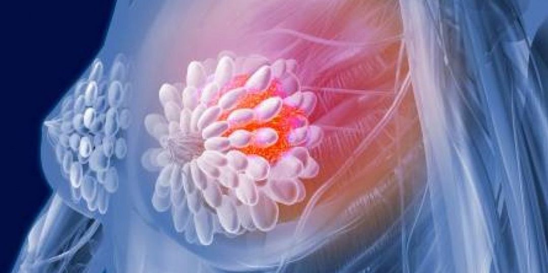 Los mejores investigadores del mundo sobre el cáncer de mama llegan a Toledo Los mejores investigadores del mundo sobre el cáncer de mama llegan a Toledo