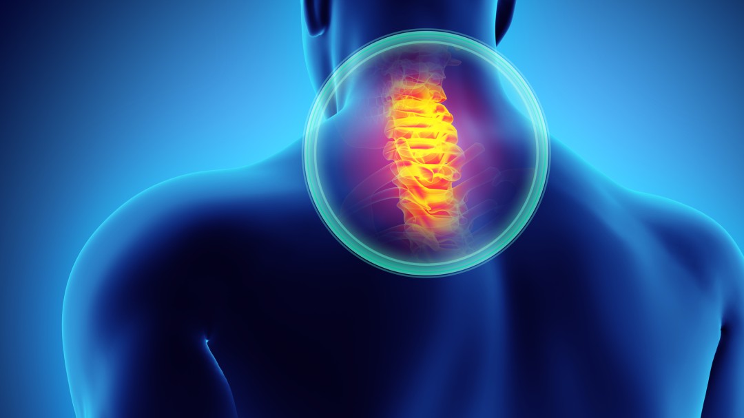 Las lesiones en la columna vertebral, muy frecuentes en accidentes de tráfico