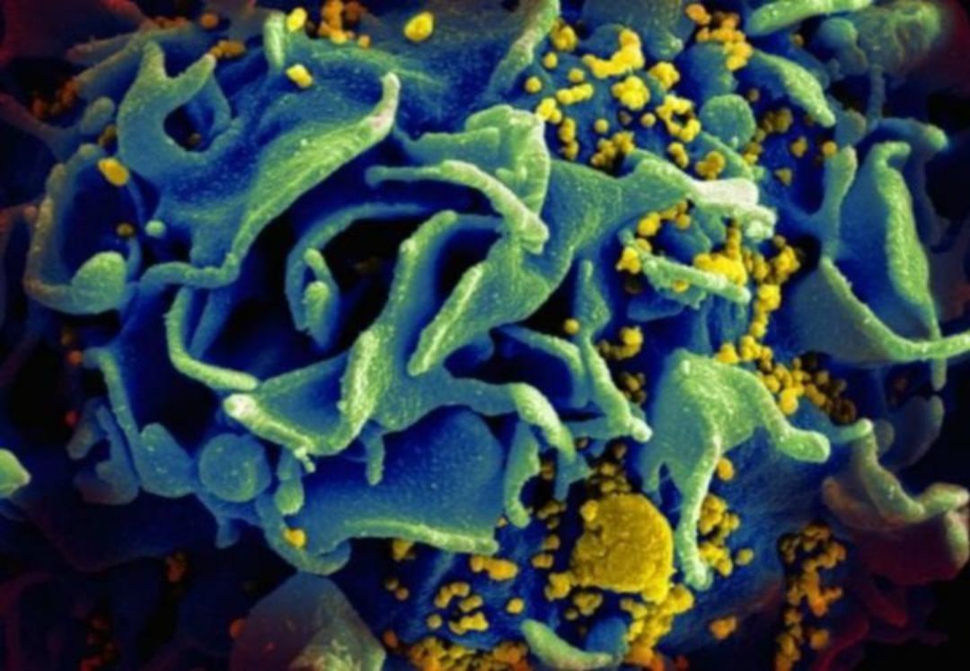 Imagen microscópica de una célula T infectada con VIH.
Imagen microscópica de una célula T infectada con VIH.
