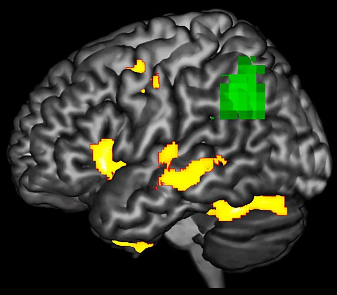 Imagen de un cerebro afectado por un proceso de neurodegeneración.
Imagen de un cerebro afectado por un proceso de neurodegeneración.