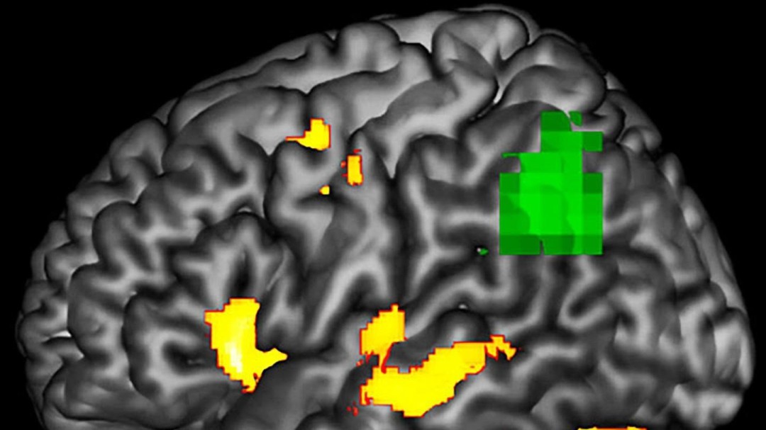 Un biomarcador no invasivo podría detectar el Parkinson