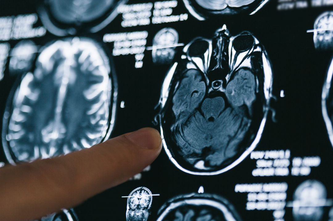 La investigación contra el Alzhéimer avanza. La investigación contra el Alzhéimer avanza.