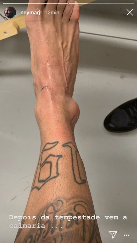 Neymar muestra su tobillo en las redes Neymar muestra su tobillo en las redes