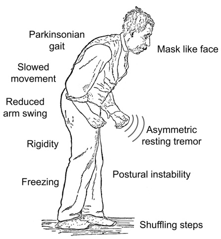 Los síntomas relacionados con el movimiento de la enfermedad de Parkinson. Imagen perteneciente a la obra 'Diseases of the Nervous System', de William Gowers Los síntomas relacionados con el movimiento de la enfermedad de Parkinson. Imagen perteneciente a la obra 'Diseases of the Nervous System', de William Gowers