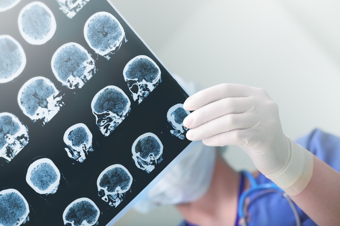 Cuatro síntomas que podrían indicar que padecerá Parkinson Cuatro síntomas que podrían indicar que padecerá Parkinson