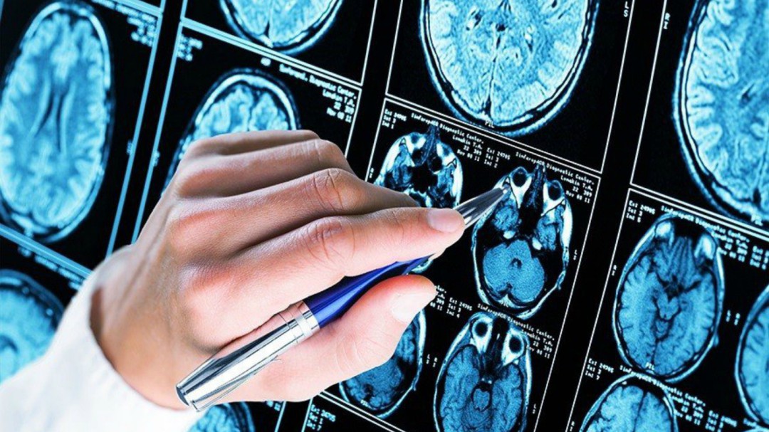 Identifican un mecanismo desconocido del Alzhéimer
