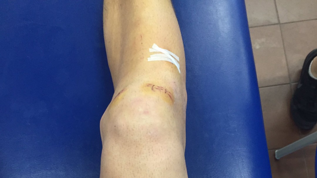 La increíble evolución de la rodilla de Sergi Vidal