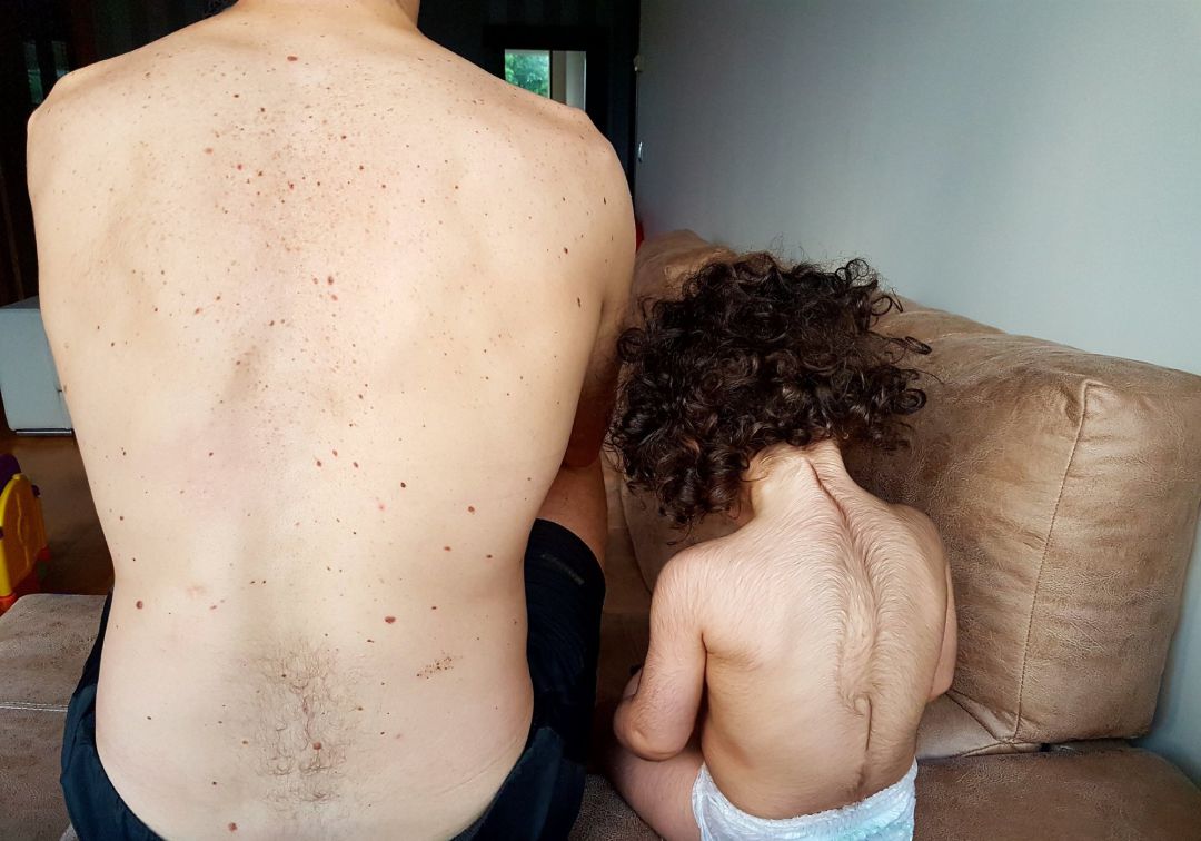 Nuevo caso por el suministro de "minoxidil" como omeprazol a bebes