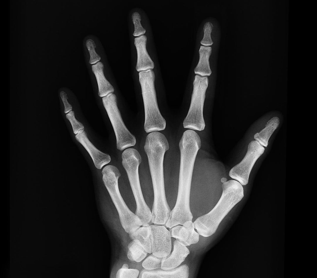 Radiografía de la mano de una persona afectada por hipofosfatasia Radiografía de la mano de una persona afectada por hipofosfatasia