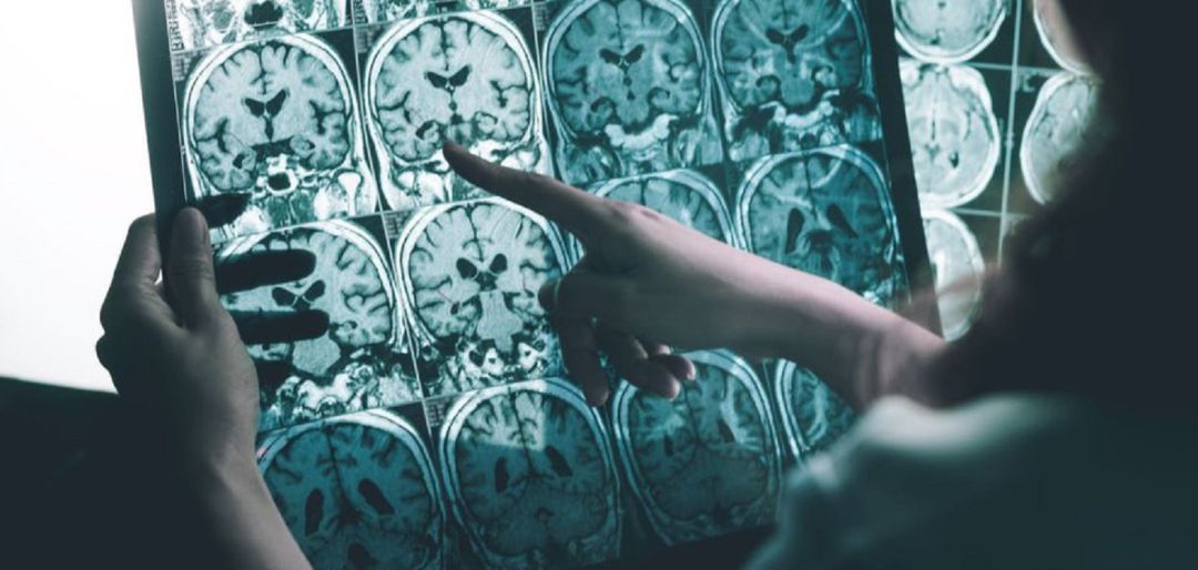 Entrevista en 'Hoy por Hoy' al neurólogo Gurutz Linazasoro sobre el alzheimer Entrevista en 'Hoy por Hoy' al neurólogo Gurutz Linazasoro sobre el alzheimer
