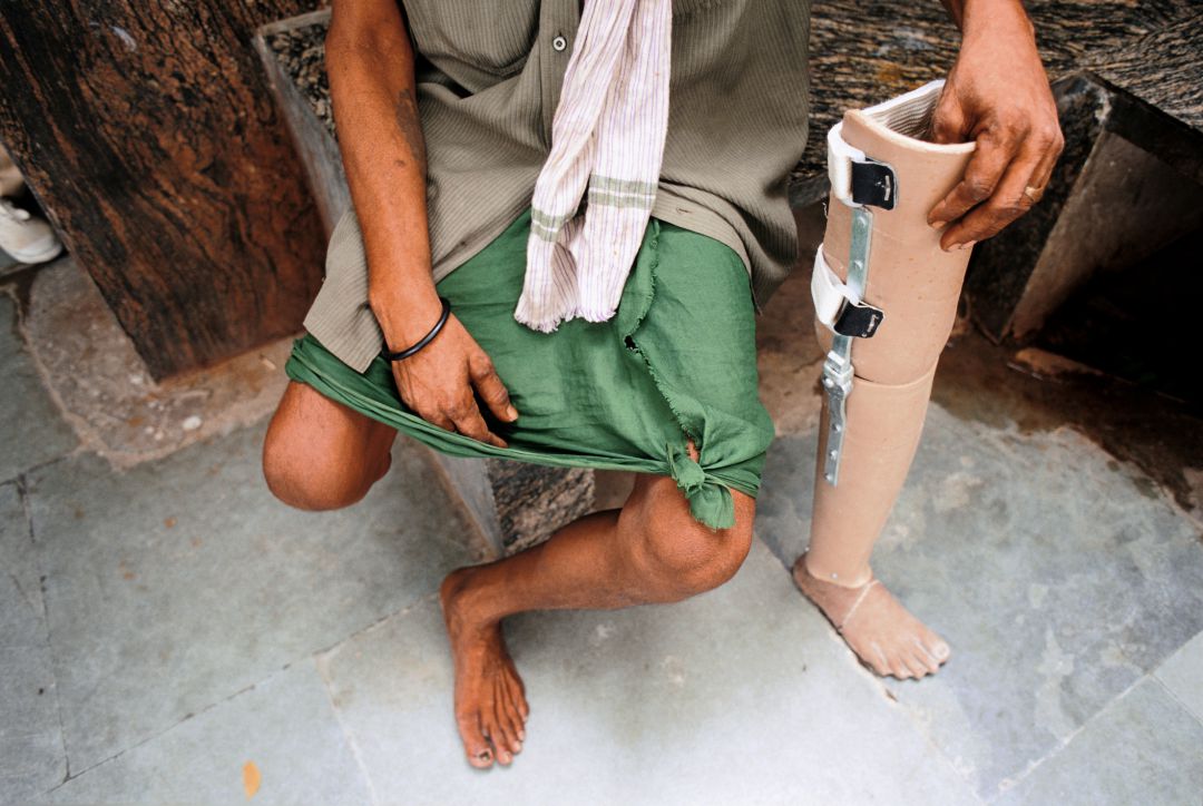 "En el sur de India una prótesis marca la diferencia entre la vida y la muerte" "En el sur de India una prótesis marca la diferencia entre la vida y la muerte"