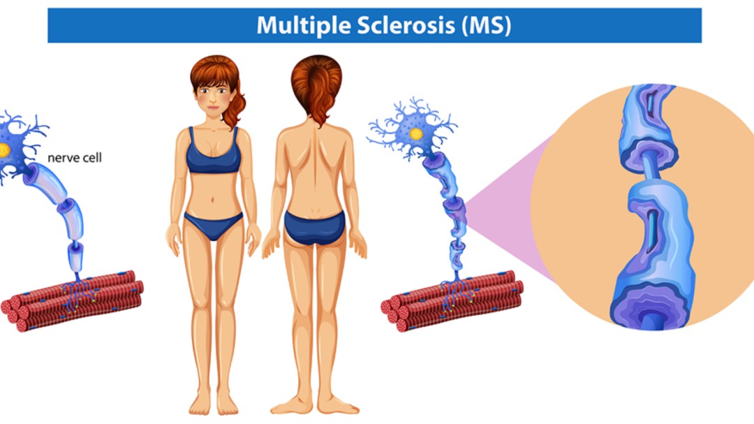 Día del socio de la Asociación Mostoleña de Esclerosis Múltiple