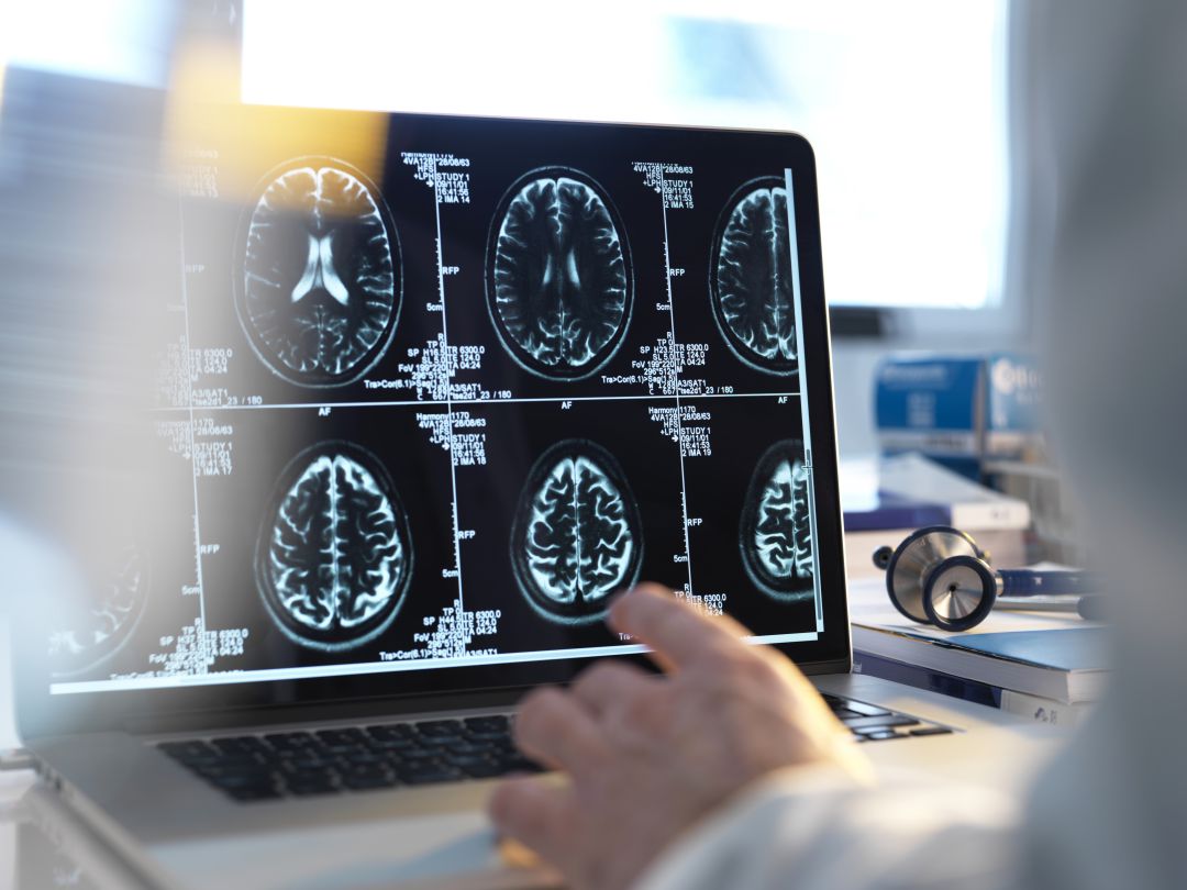 'Cognition', el proyecto que investiga la apnea del sueño en los niños 'Cognition', el proyecto que investiga la apnea del sueño en los niños