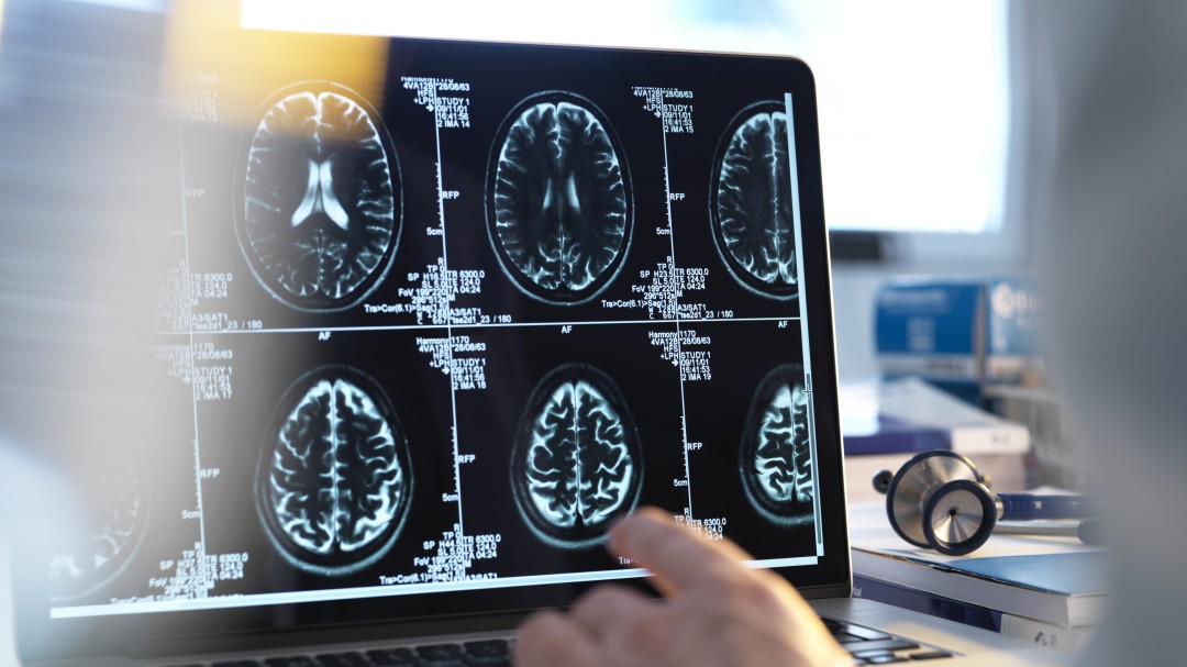 'Cognition', el proyecto que investiga la apnea del sueño en los niños