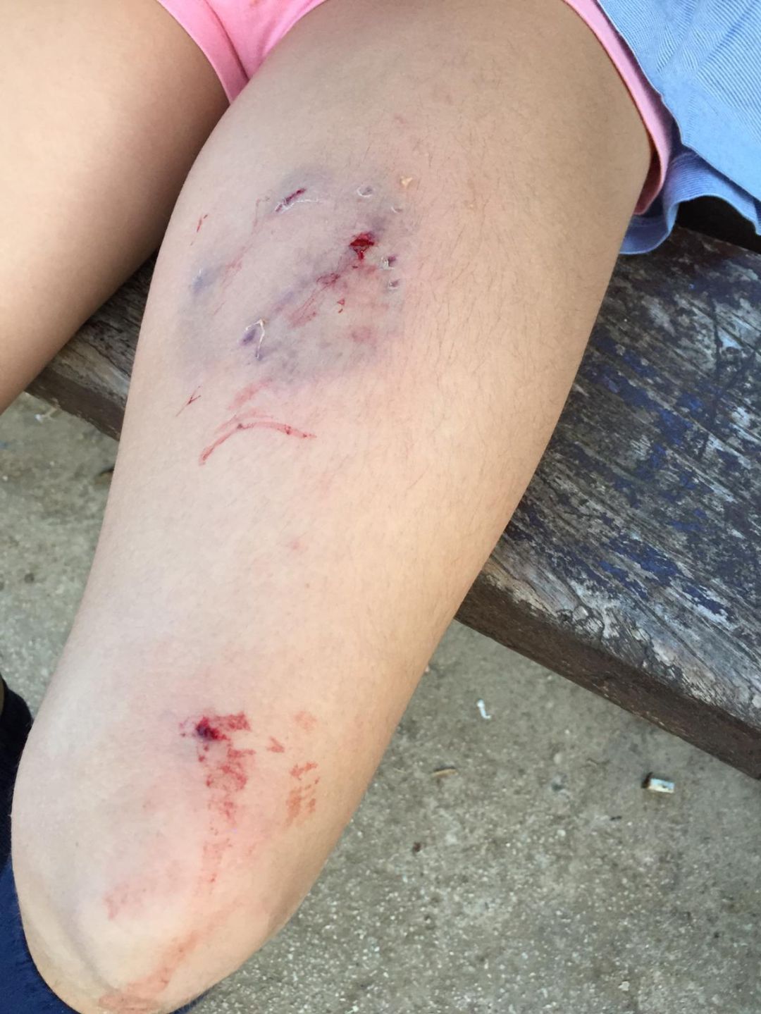 Heridas ocasionadas a una de las niñas por el perro. Heridas ocasionadas a una de las niñas por el perro.