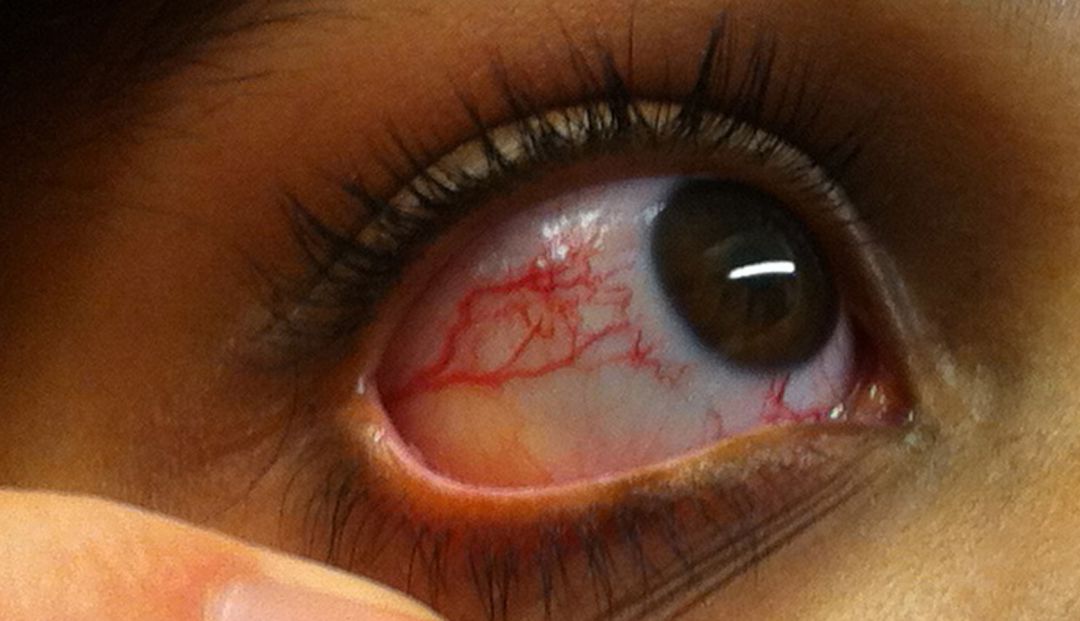 Telangiectasia ocular en una persona con A-T Telangiectasia ocular en una persona con A-T