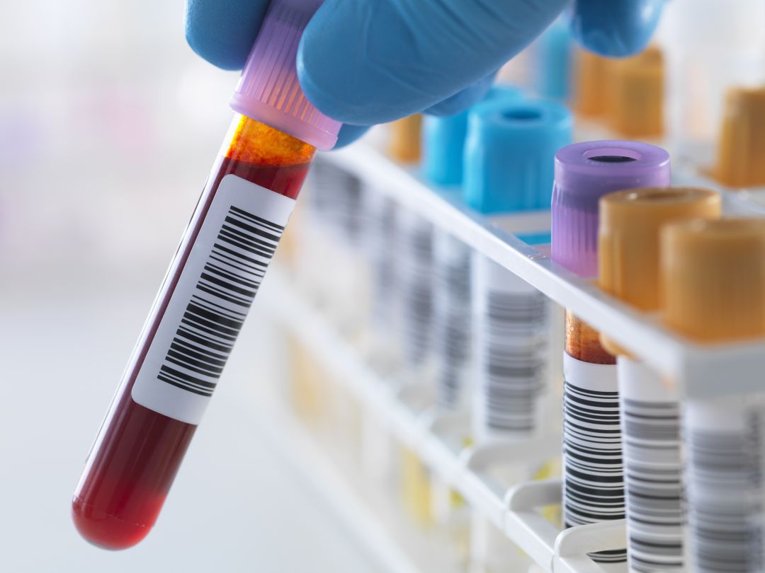 Detectar el riesgo genético de padecer Alzheimer con un análisis de sangre Detectar el riesgo genético de padecer Alzheimer con un análisis de sangre