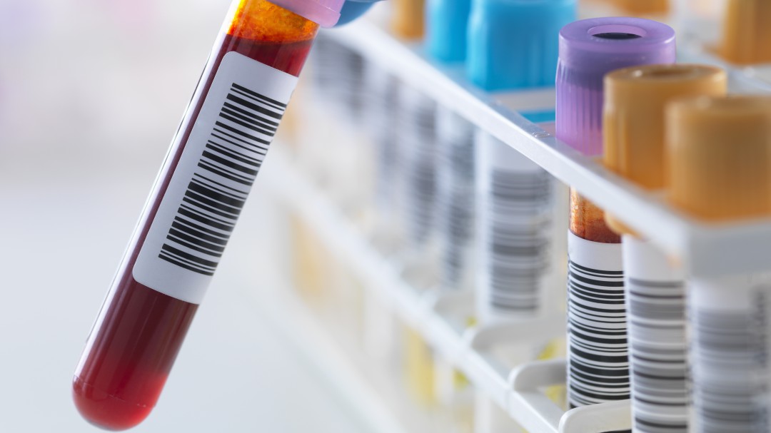Detectar el riesgo genético de padecer Alzheimer con un análisis de sangre