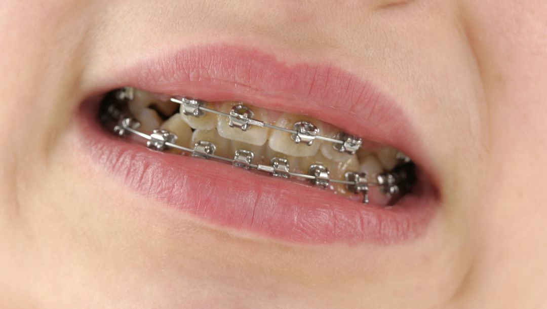El acusado le arrancóa su pareja los brackets de un puñetazo El acusado le arrancóa su pareja los brackets de un puñetazo
