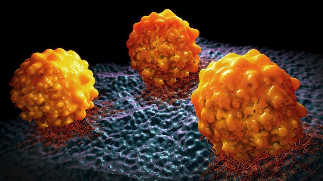 Cáncer de páncreas
Cáncer de páncreas