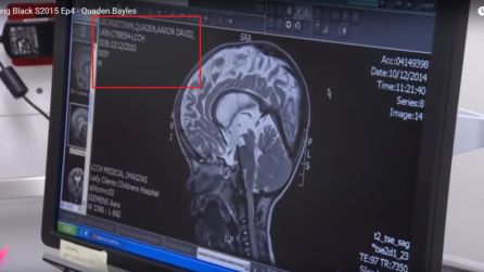Resonancia magnética que muestra la edad de Quaden Resonancia magnética que muestra la edad de Quaden