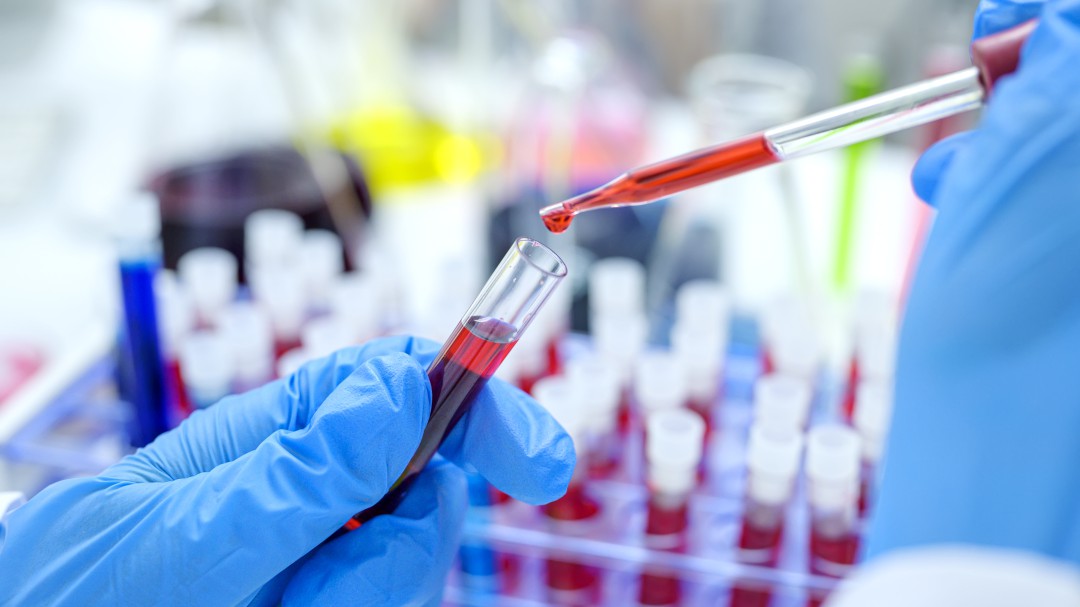 Los médicos confirman la segunda curación del mundo de un paciente con VIH
