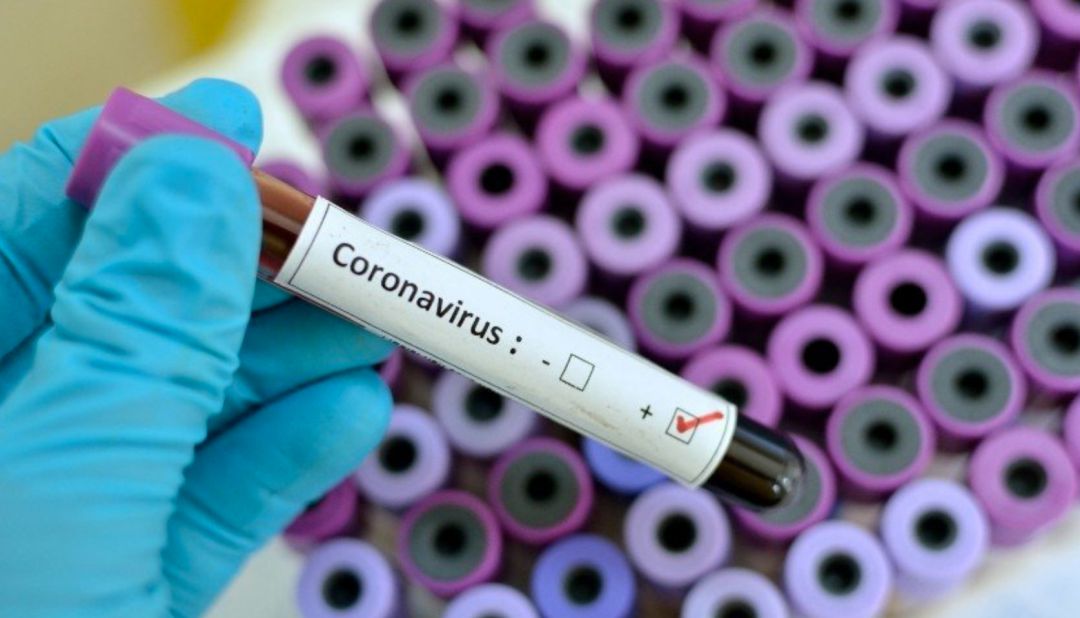 Muestra de un análisis de coronavirus Muestra de un análisis de coronavirus
