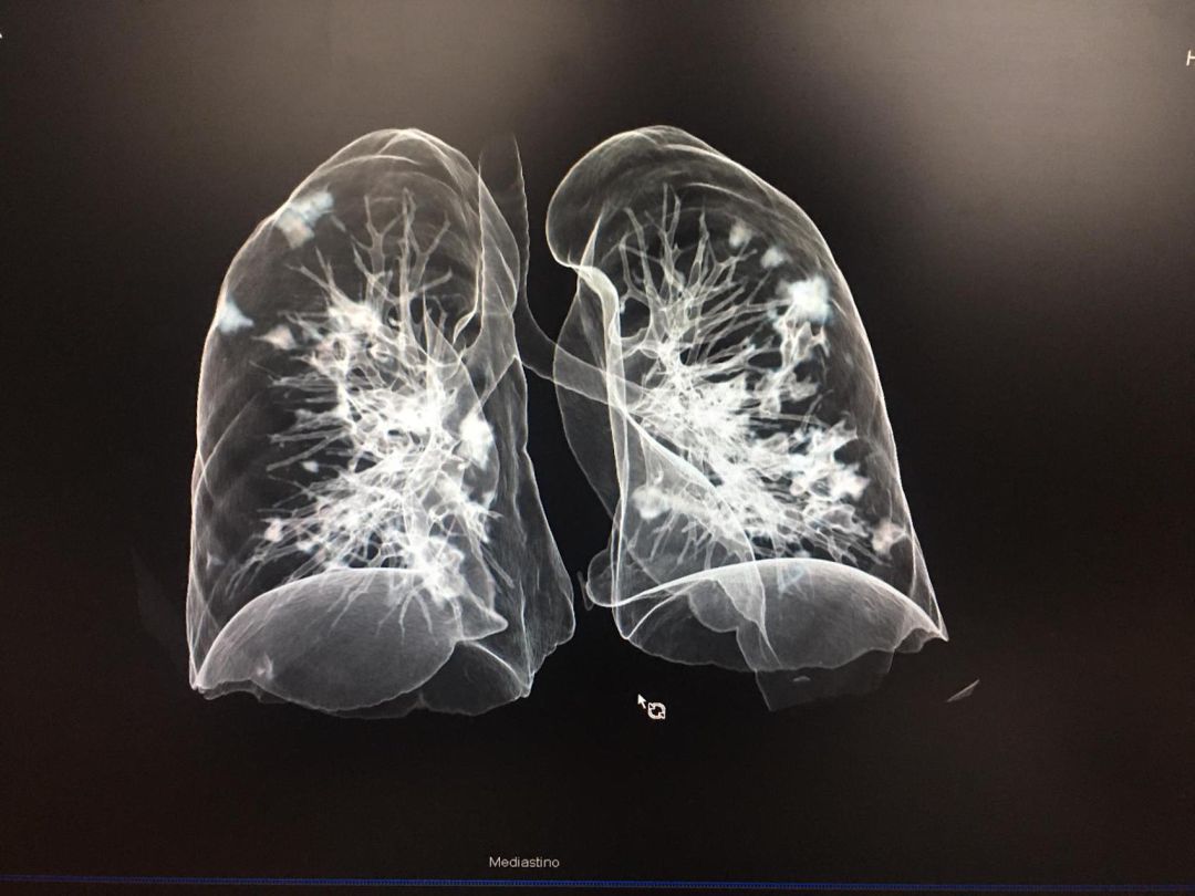 Imagen de la reconstrucción de una radiografía pulmonar en 3D con COVID-19 Imagen de la reconstrucción de una radiografía pulmonar en 3D con COVID-19
