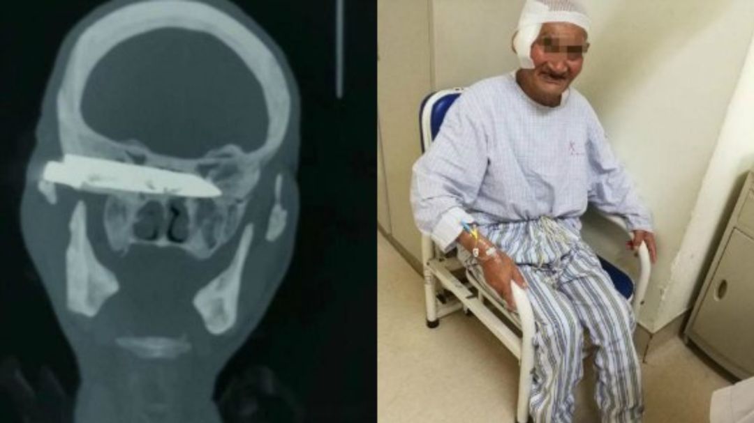 Extraen un cuchillo de 10 cm de la cabeza de un hombre de 76 en China Extraen un cuchillo de 10 cm de la cabeza de un hombre de 76 en China