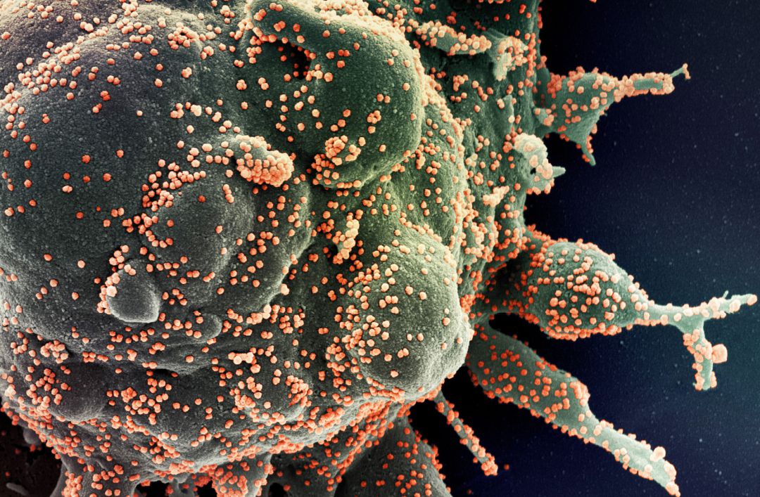 Micrografía electrónica de barrido coloreada de una célula apoptótica, en verde, infectada con partículas del virus SARS-COV-2, en color naranja, aislada de una muestra de paciente, capturada y mejorada por Centro de Investigación Integrada del Instituto estadounidense de Alergia y Enfermedades Infecciosas (NIAID), en Hamilton. Micrografía electrónica de barrido coloreada de una célula apoptótica, en verde, infectada con partículas del virus SARS-COV-2, en color naranja, aislada de una muestra de paciente, capturada y mejorada por Centro de Investigación Integrada del Instituto estadounidense de Alergia y Enfermedades Infecciosas (NIAID), en Hamilton.