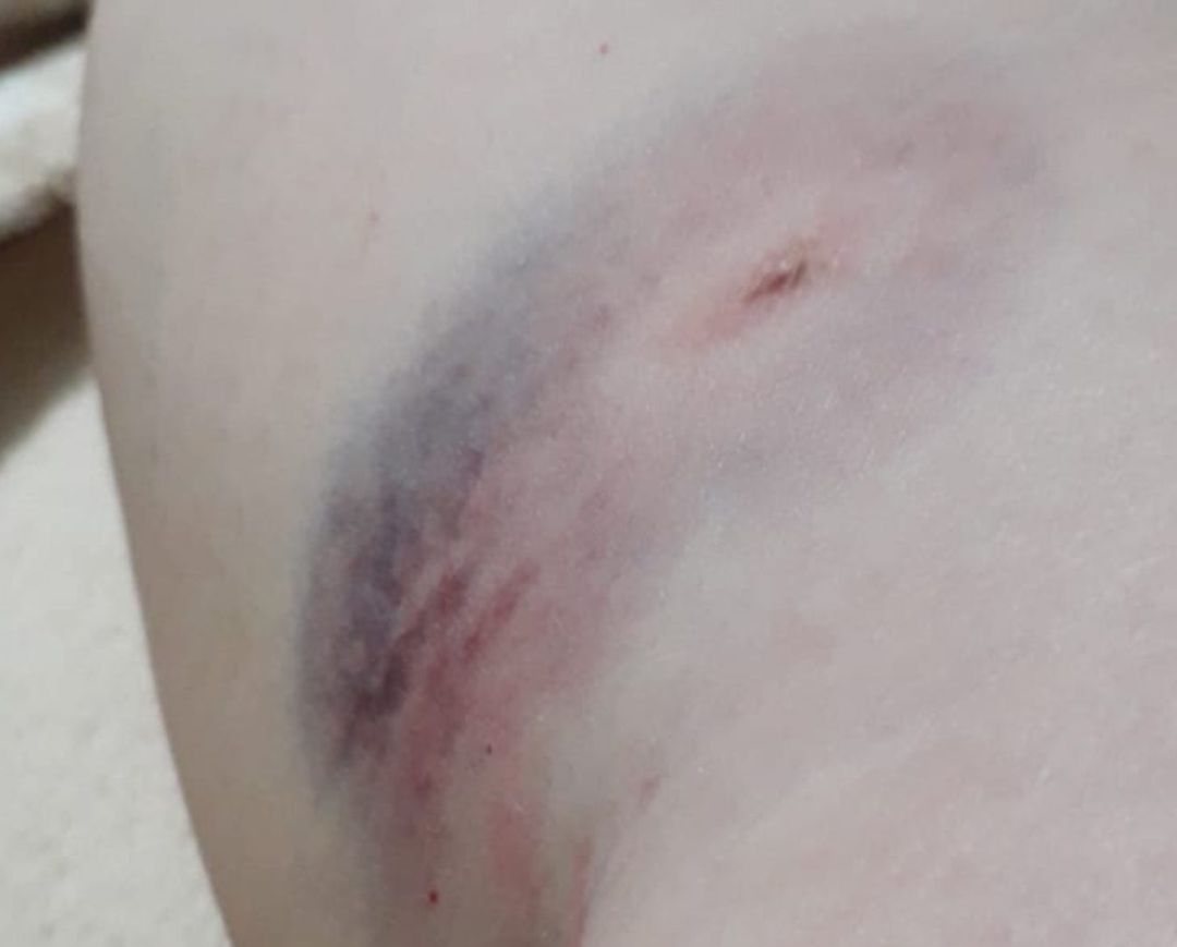 Heridas que le provocó el perro a Marian Adán. Heridas que le provocó el perro a Marian Adán.