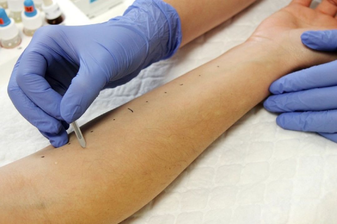 Imagen de una prueba de alergia Imagen de una prueba de alergia