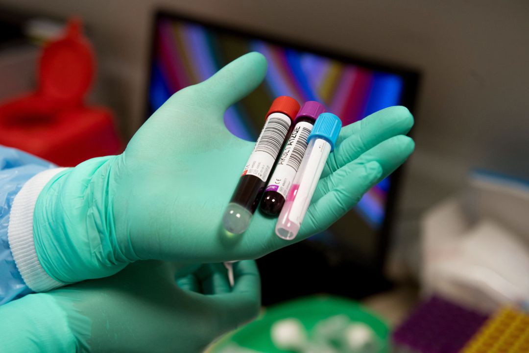 A health worker shows samples to be tested for the novel coronavirus COVID-19 at a clinic of Semmelweis Medical University in Budapest, Hungary A health worker shows samples to be tested for the novel coronavirus COVID-19 at a clinic of Semmelweis Medical University in Budapest, Hungary