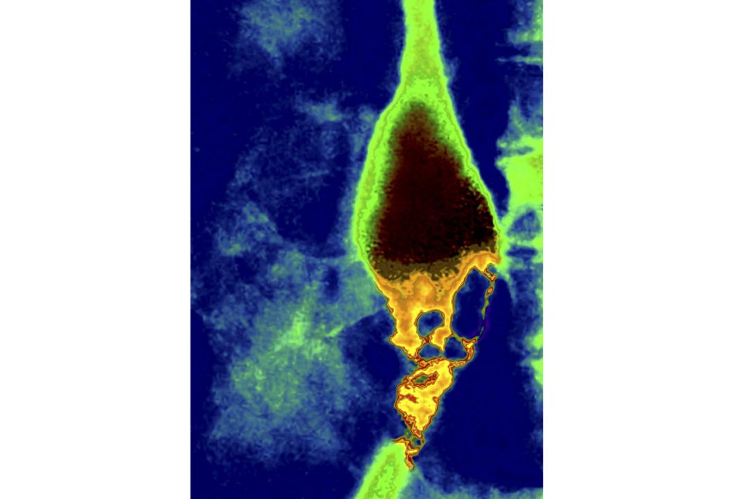 Imagen de Rayos X de un cáncer de esófago Imagen de Rayos X de un cáncer de esófago