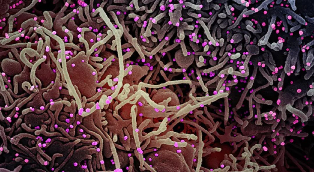 Coronavirus en el interior de una célula humana. Coronavirus en el interior de una célula humana.