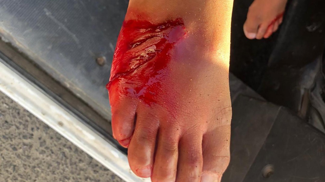 Un niño de seis años mordido por un pez en la playa de Famara