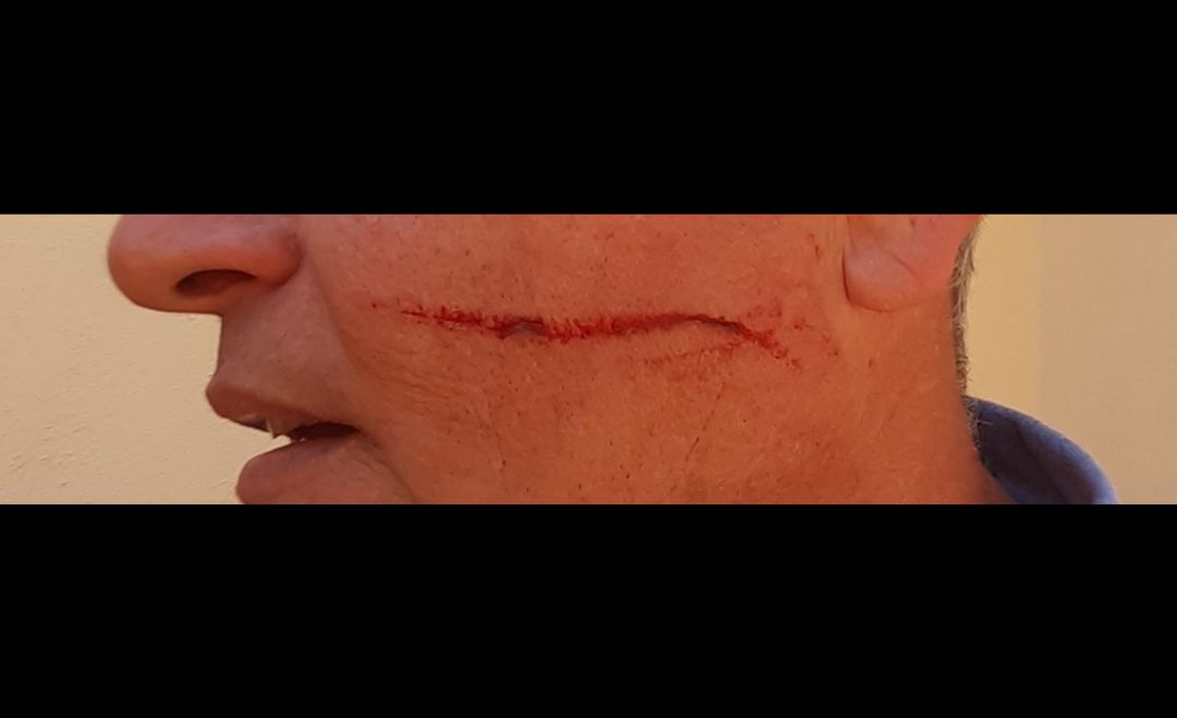 Esta es la herida causada por uno de los puñetazos recibidos por el entonces coordinador de Vox en Aldeaquemada (Jaén) Esta es la herida causada por uno de los puñetazos recibidos por el entonces coordinador de Vox en Aldeaquemada (Jaén)
