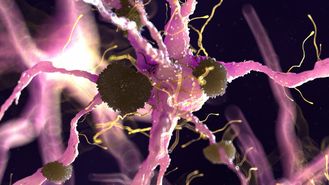 Neuronas afectadas por una enfermedad neurológica. Neuronas afectadas por una enfermedad neurológica.