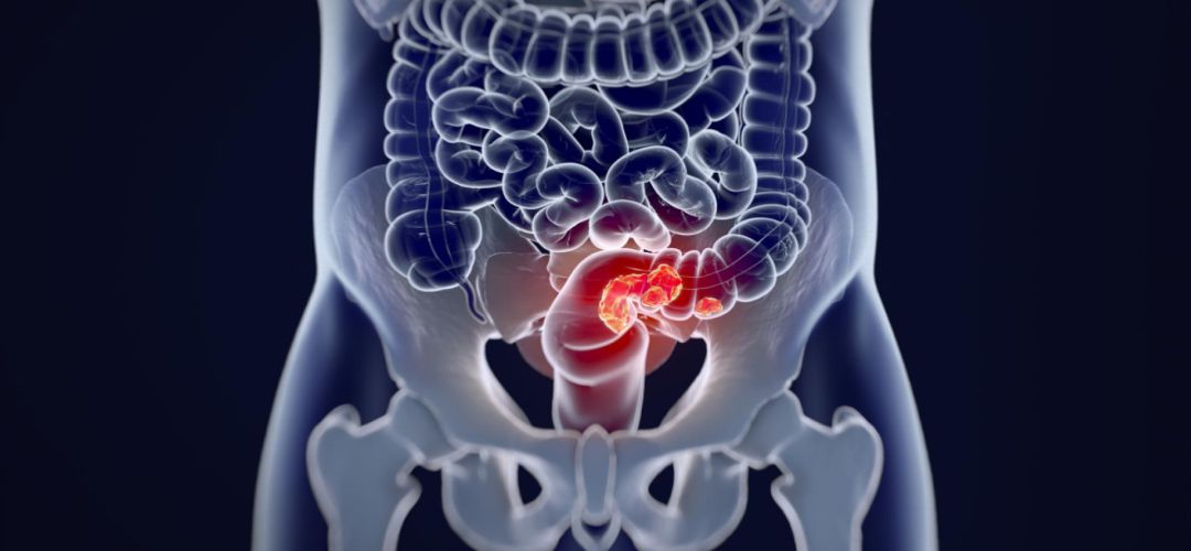 Imagen de cáncer colorrectal Imagen de cáncer colorrectal