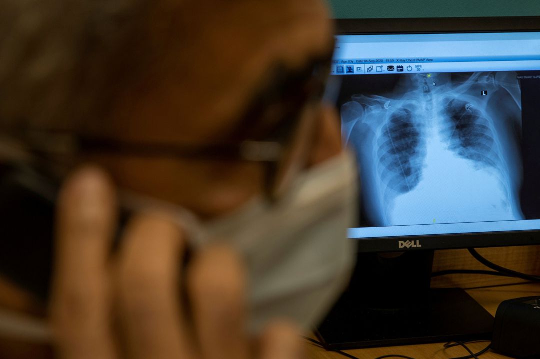 Radiografía de un paciente con COVID-19 Radiografía de un paciente con COVID-19