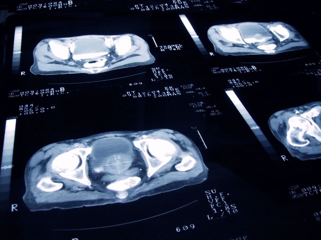 El trabajo se ha realizado sobre cerca de medio millón de certificados de defunción por cánceres urológicos (cáncer de próstata, cáncer de vejiga y cáncer de riñón) entre los años 2004 y 2013 en los 14 municipios con mayor población de la Comunidad de Madrid. El trabajo se ha realizado sobre cerca de medio millón de certificados de defunción por cánceres urológicos (cáncer de próstata, cáncer de vejiga y cáncer de riñón) entre los años 2004 y 2013 en los 14 municipios con mayor población de la Comunidad de Madrid.