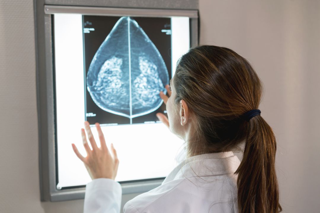 Los Comités de Tumores mejoran la supervivencia de las pacientes con cáncer de mama en un 10% Los Comités de Tumores mejoran la supervivencia de las pacientes con cáncer de mama en un 10%