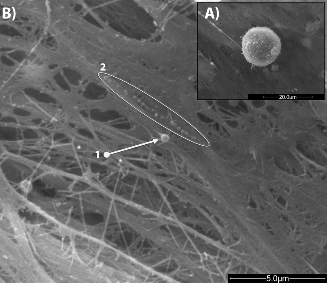 Imágenes SEM de unas célula madres mesenquimales en cultivo. B) 1. Imagen de microvesícula (diámetro 460 nm) y 2. conjunto de exosomas (diámetro medio 140nm) secretados por las células MSCs: Las imágenes se obtuvieron con un microscopio de barrido de alta resolución (HRSEM), AURIGA Carl Zeiss SMT. Imágenes SEM de unas célula madres mesenquimales en cultivo. B) 1. Imagen de microvesícula (diámetro 460 nm) y 2. conjunto de exosomas (diámetro medio 140nm) secretados por las células MSCs: Las imágenes se obtuvieron con un microscopio de barrido de alta resolución (HRSEM), AURIGA Carl Zeiss SMT.