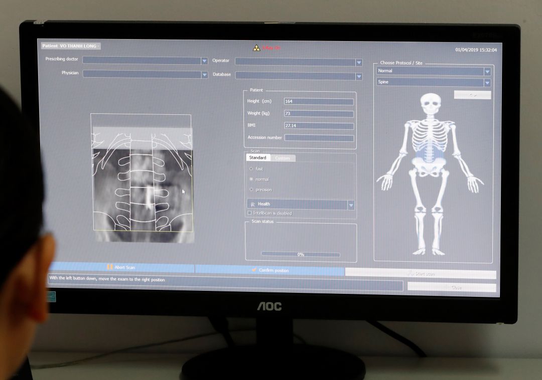 Aplicación médica para detectar la osteoporosis. Aplicación médica para detectar la osteoporosis.
