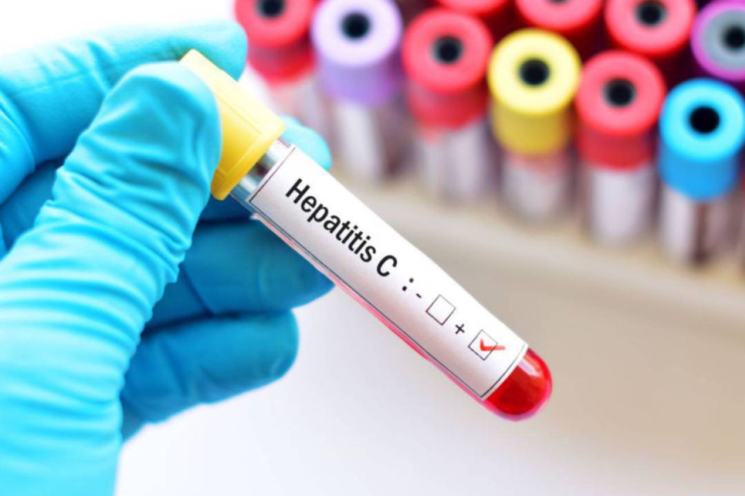 Analítica de sangre para prueba Hepatitis C Analítica de sangre para prueba Hepatitis C