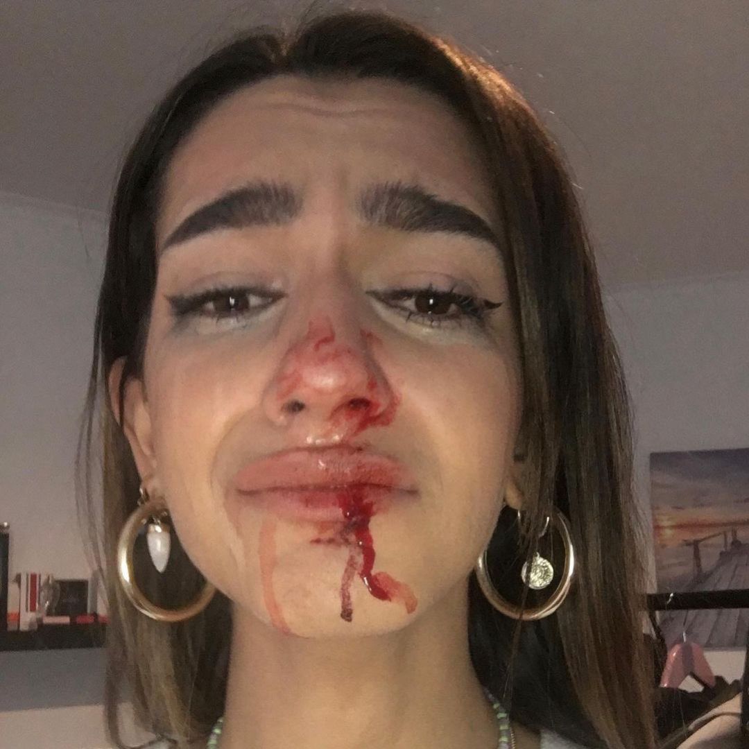 Imatge que ha publicat la víctima al seu compte de Twitter després de l'agressió Imatge que ha publicat la víctima al seu compte de Twitter després de l'agressió