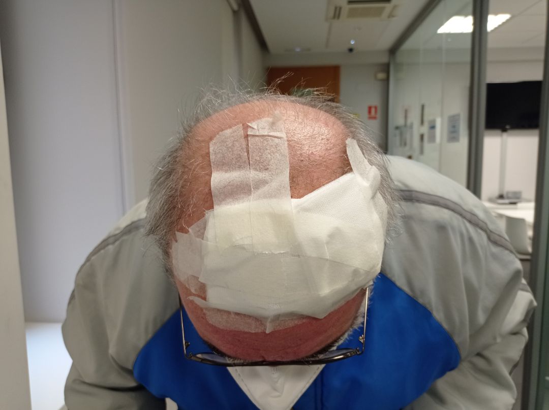 Hasta 9 grapas de sutura necesitó el hombre en la cabeza Hasta 9 grapas de sutura necesitó el hombre en la cabeza