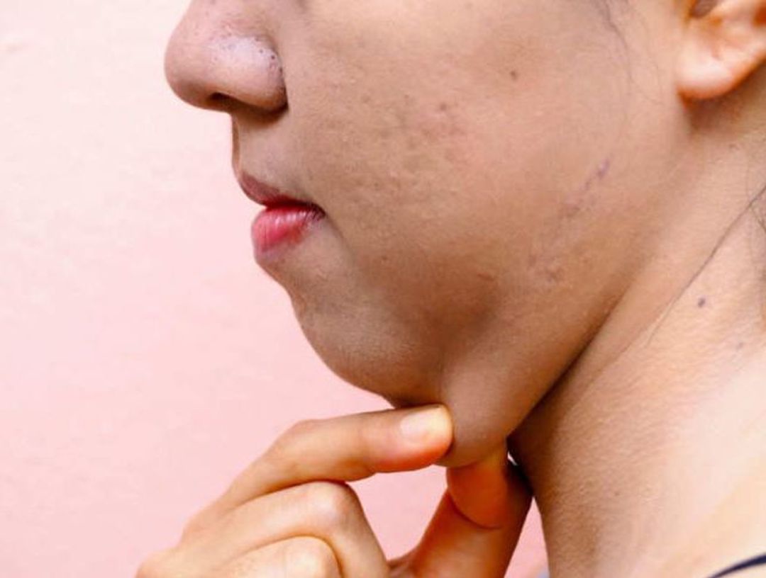 Grasa en la papada del cuello de una mujer Grasa en la papada del cuello de una mujer