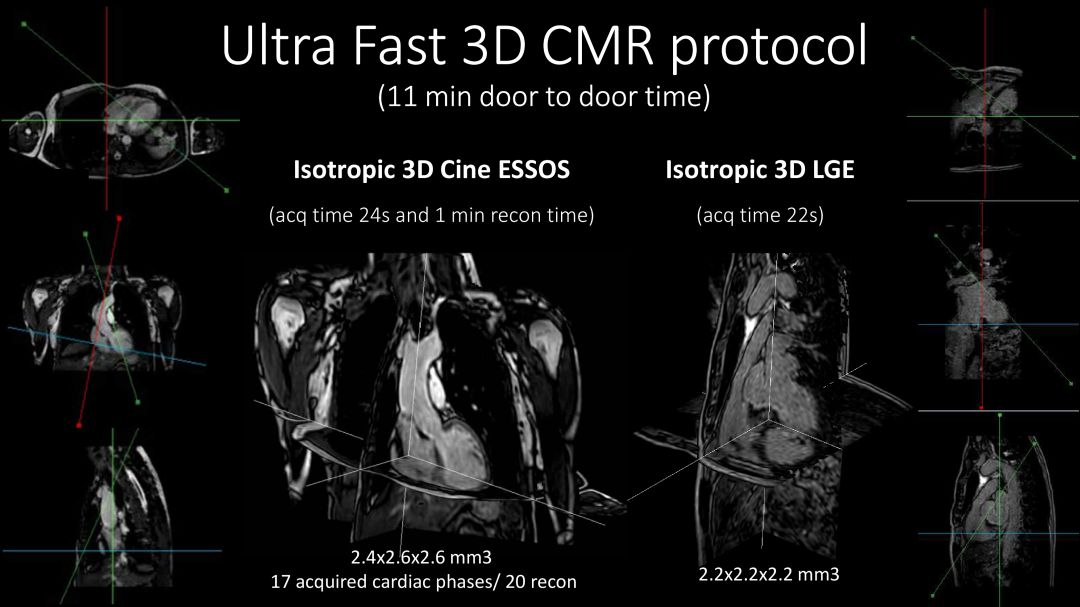 Visualización 3D de los estudios de anatomía, función y caracterización tisular adquiridos con el protocolo utra-rápido. Visualización 3D de los estudios de anatomía, función y caracterización tisular adquiridos con el protocolo utra-rápido.